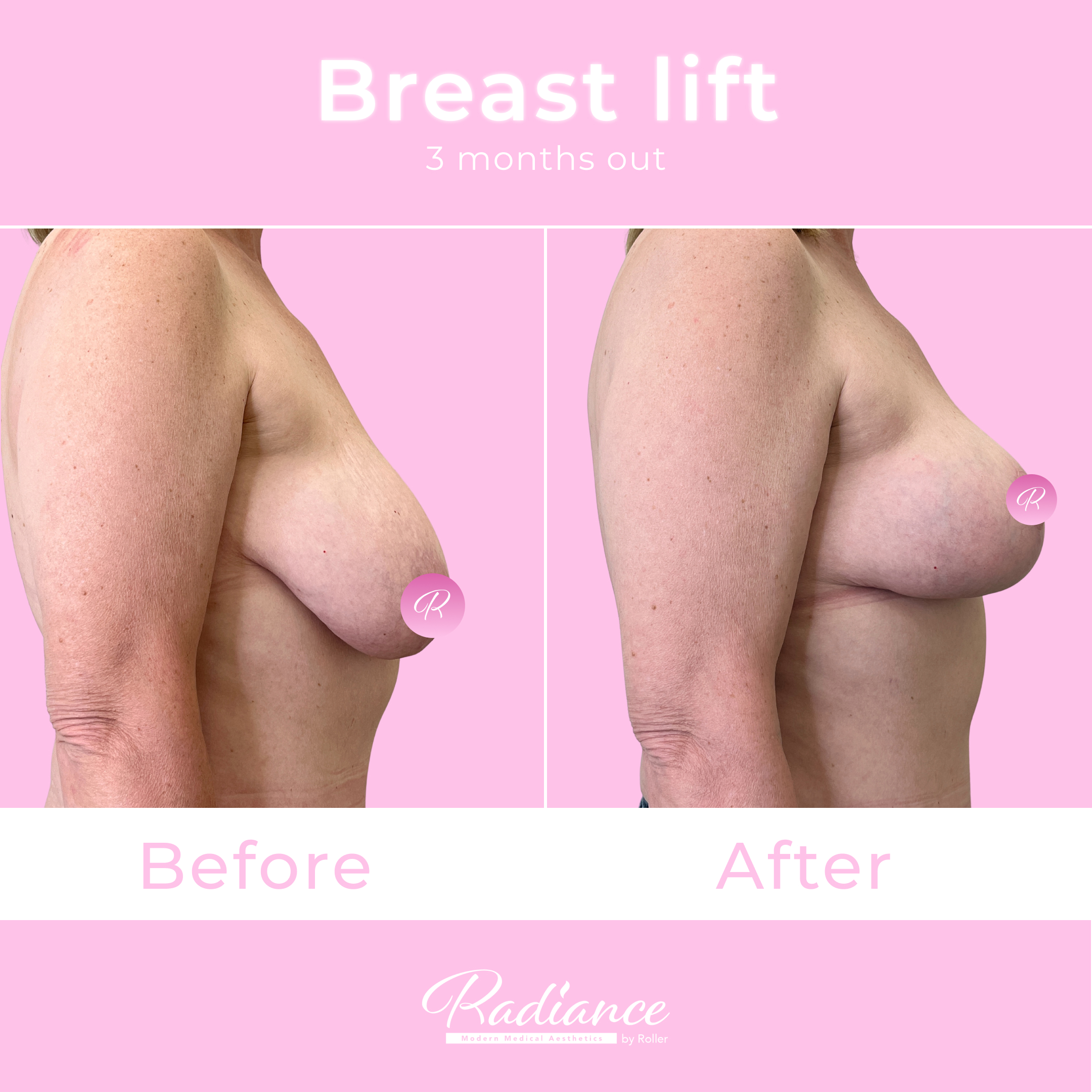 Breast Lift Before & After Gallery - Patient 13410 - Image 5