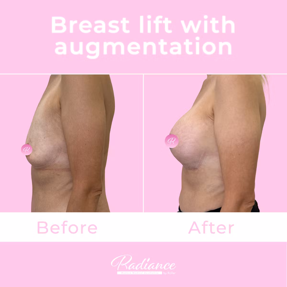 Breast Lift With Augmentation Before & After Gallery - Patient 13507 - Image 4
