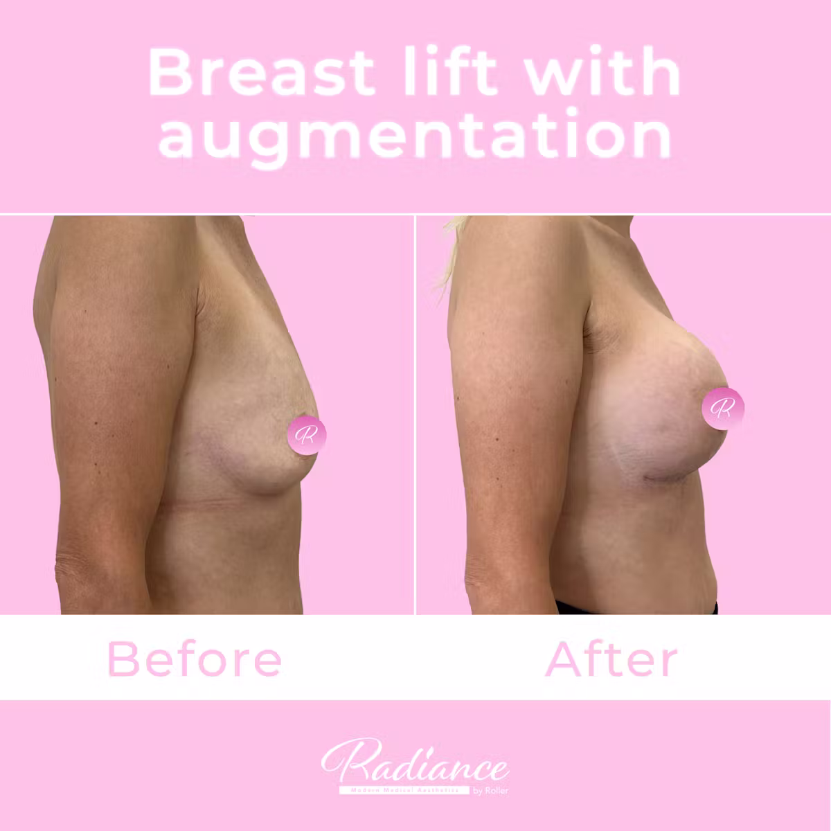 Breast Lift With Augmentation Before & After Gallery - Patient 13507 - Image 5