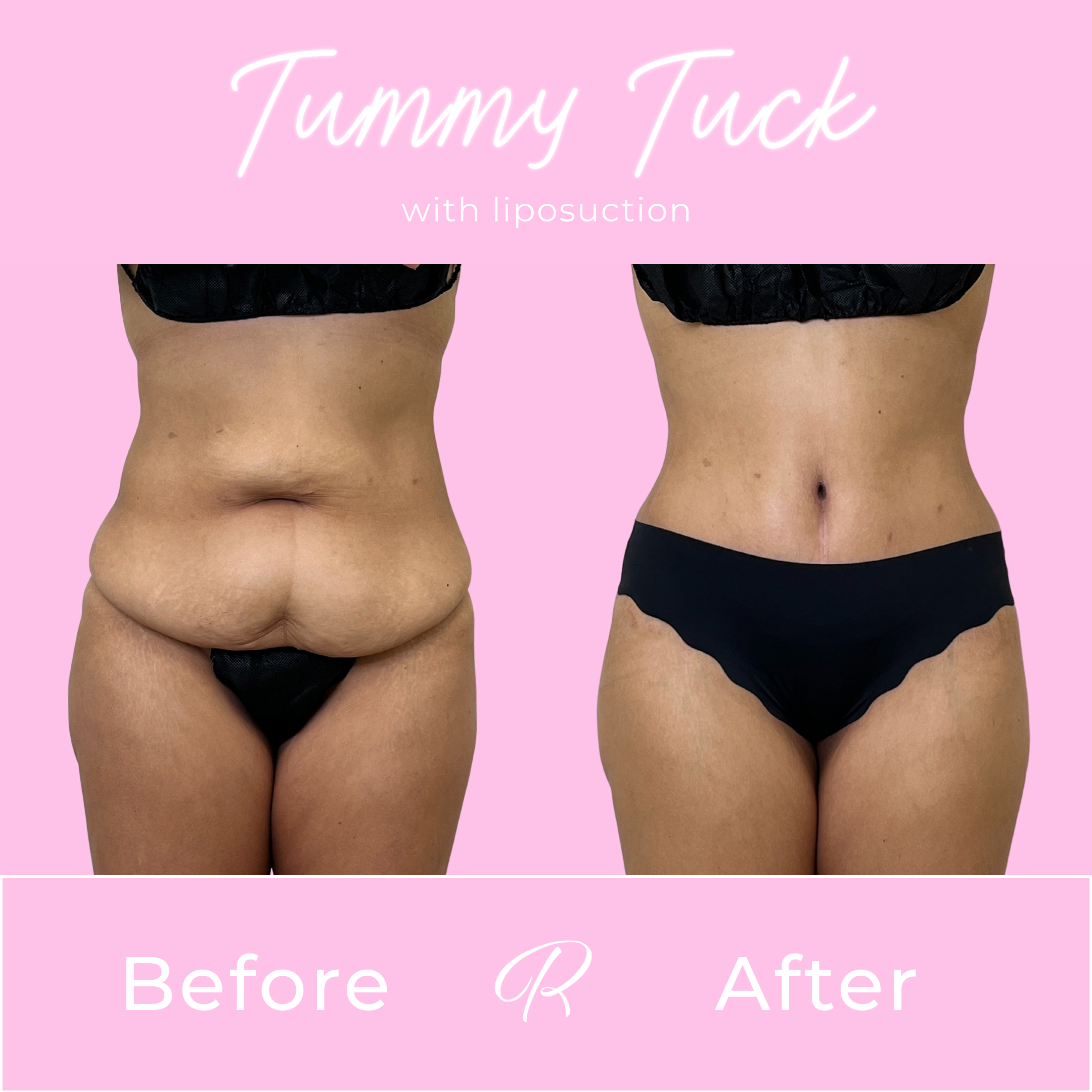 Tummy Tuck Before & After Gallery - Patient 13330 - Image 1