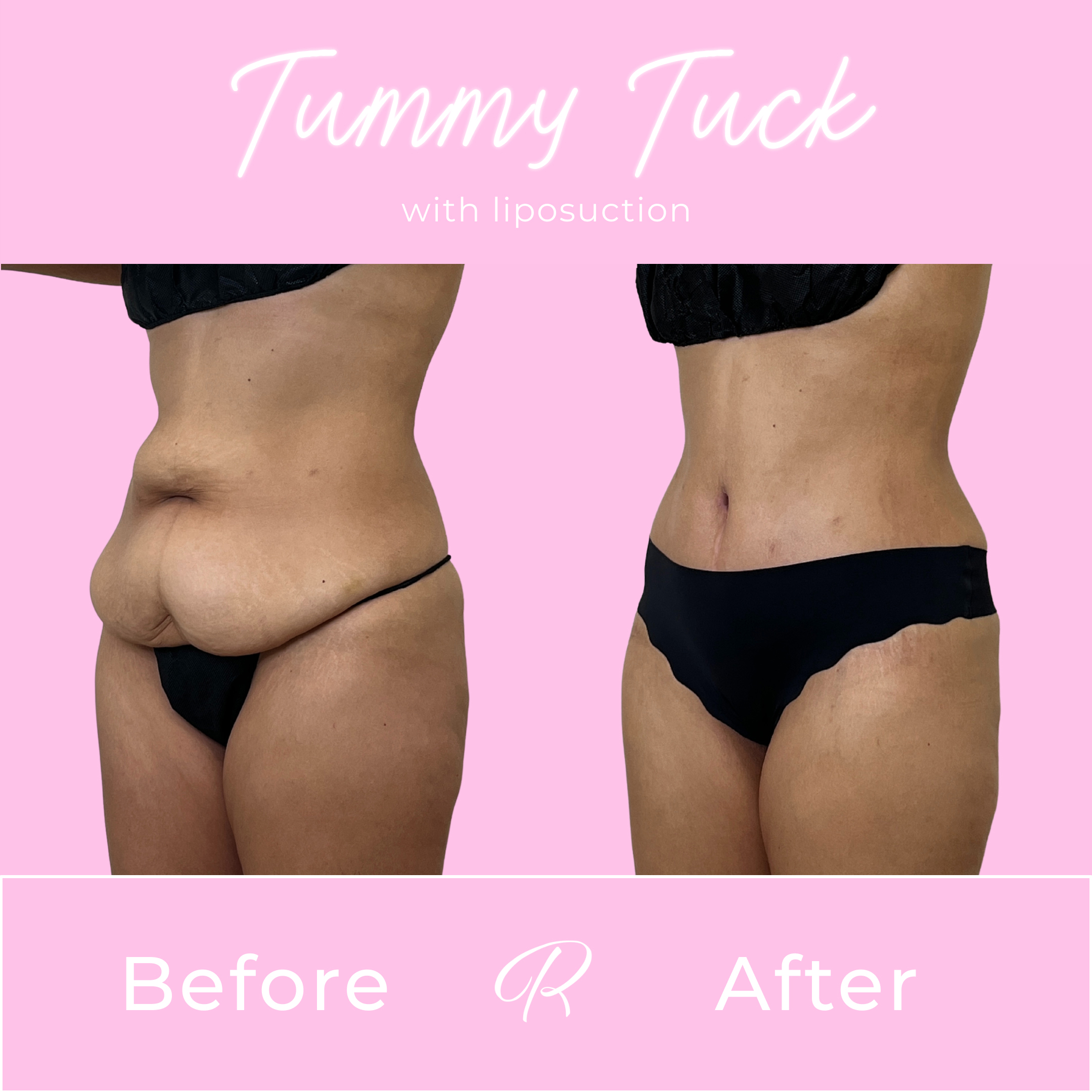 Tummy Tuck Before & After Gallery - Patient 13330 - Image 2