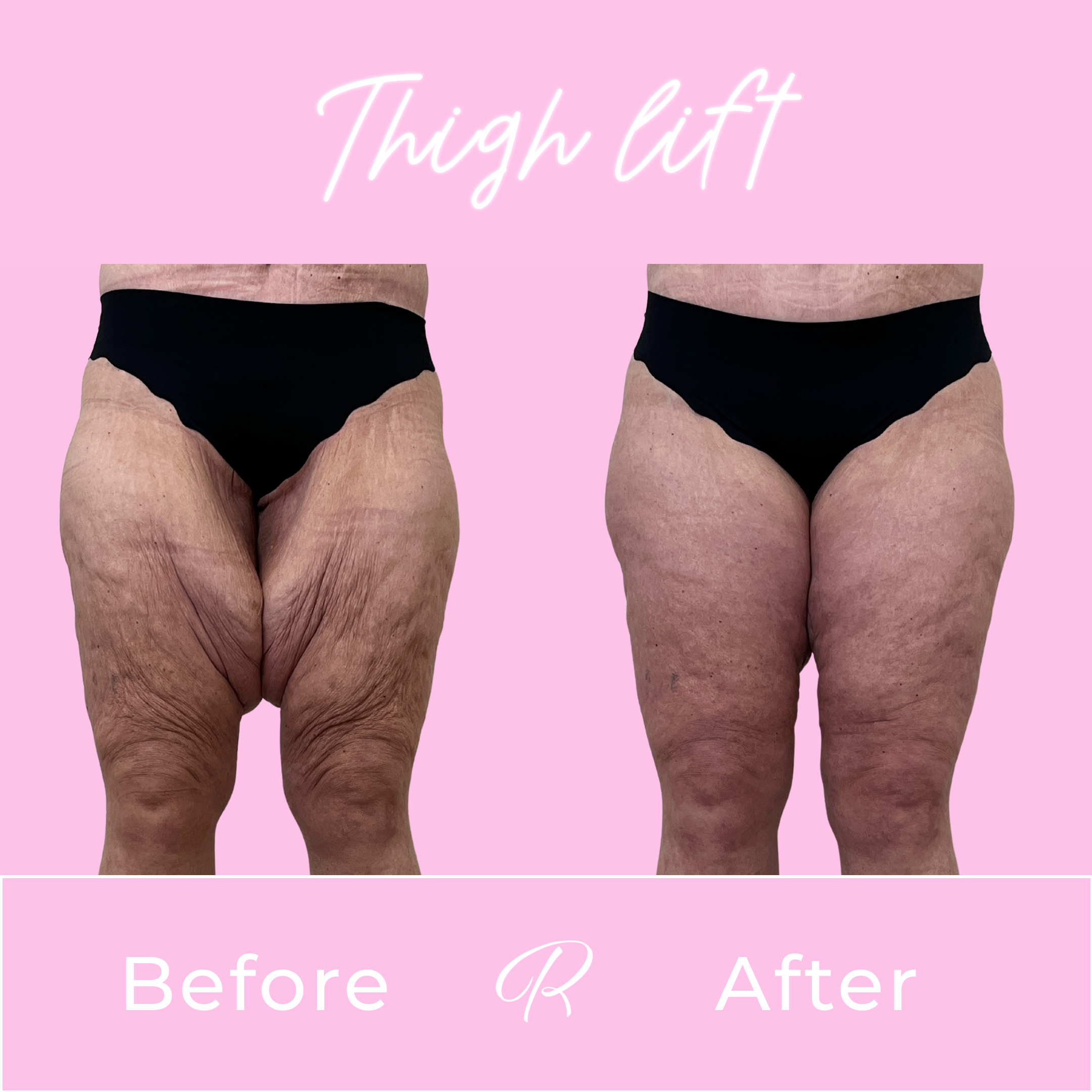 Thigh Lift Before & After Gallery - Patient 13372 - Image 1