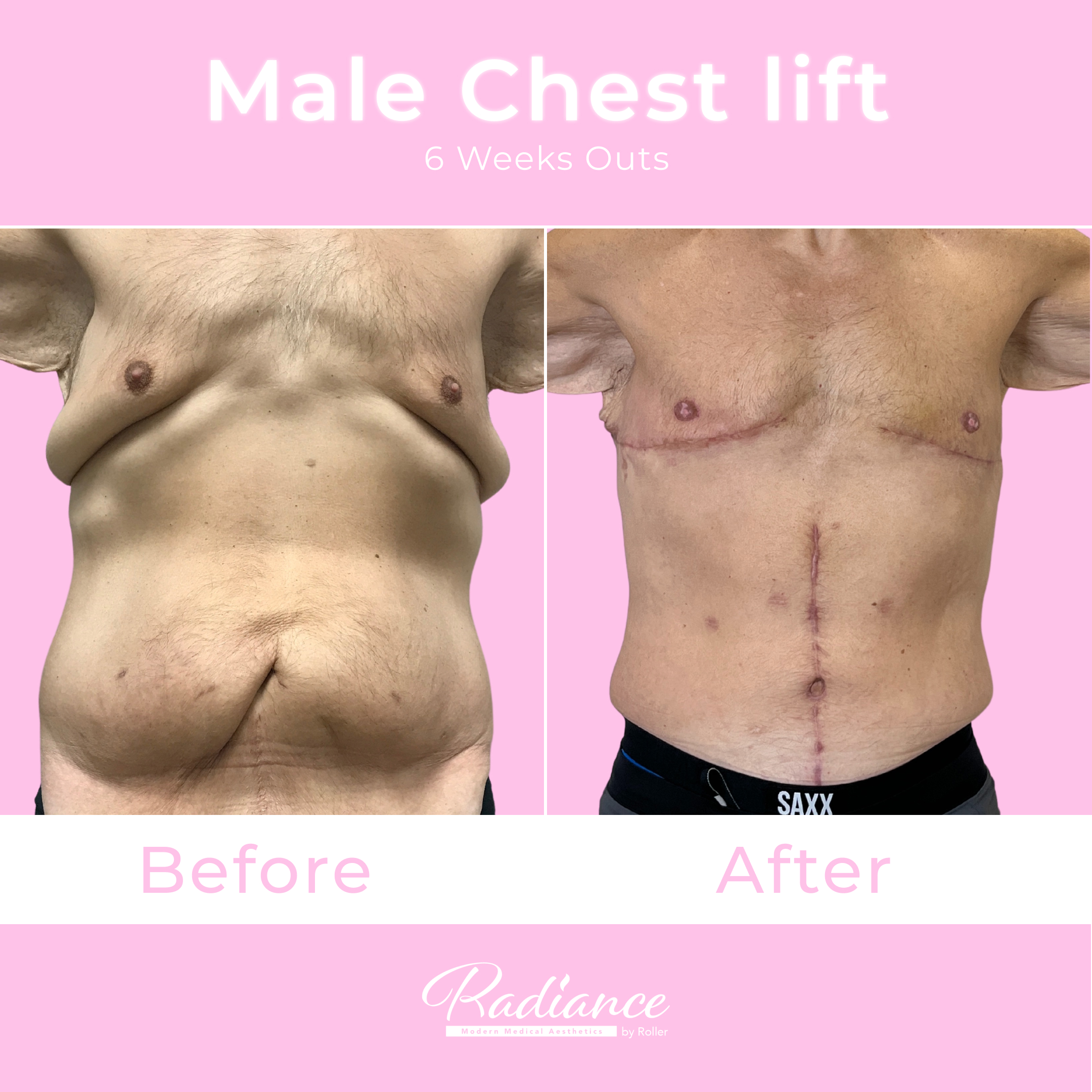 Male Chest Lift Before & After Gallery - Patient 13379 - Image 1