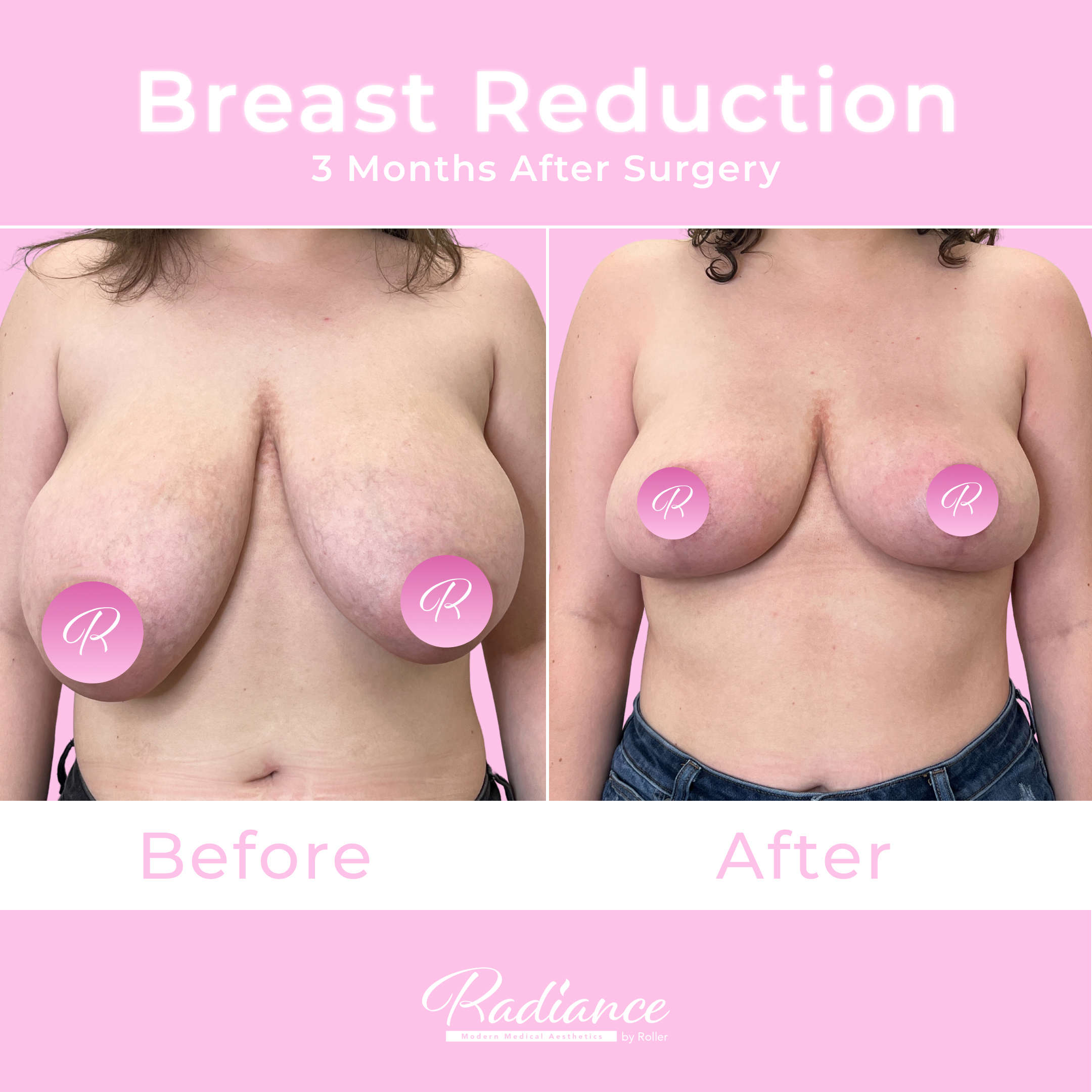 Breast Reduction Before & After Gallery - Patient 13396 - Image 1