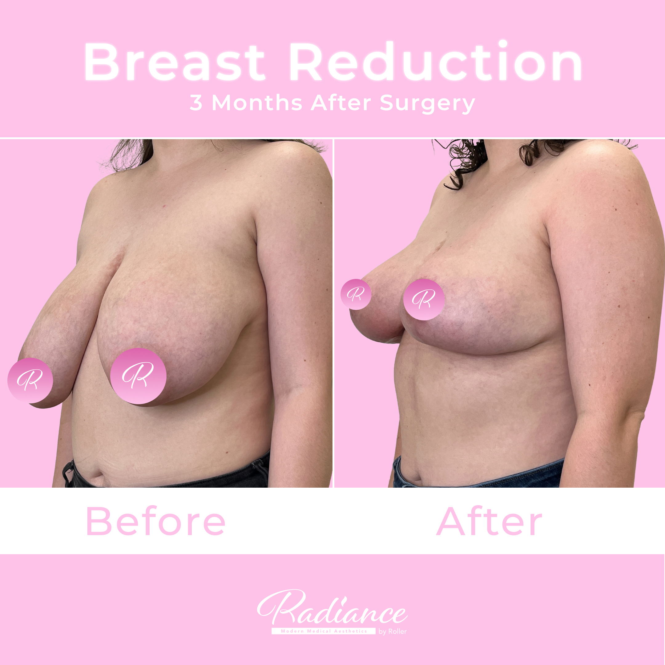 Breast Reduction Before & After Gallery - Patient 13396 - Image 2