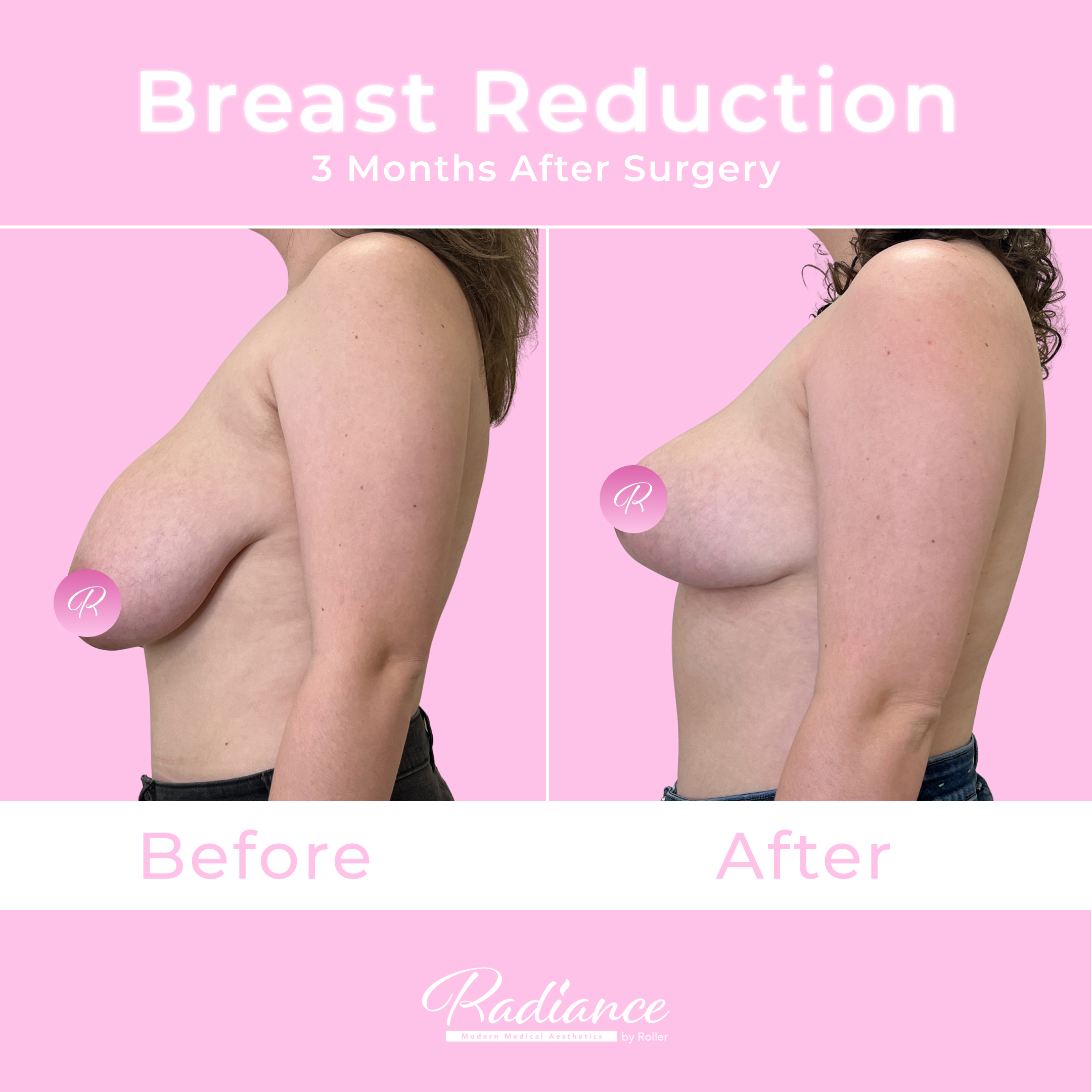 Breast Reduction Before & After Gallery - Patient 13396 - Image 4