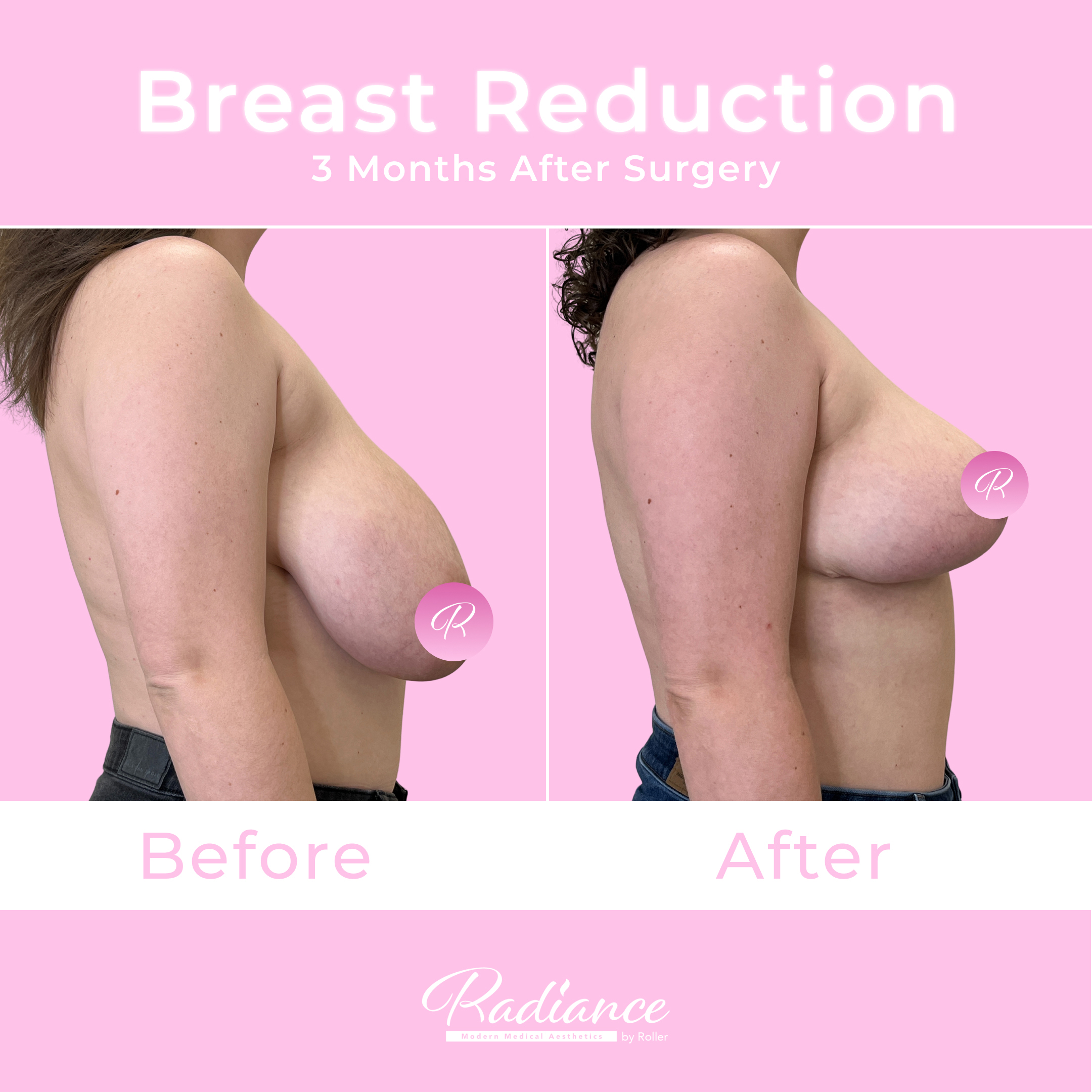 Breast Reduction Before & After Gallery - Patient 13396 - Image 5