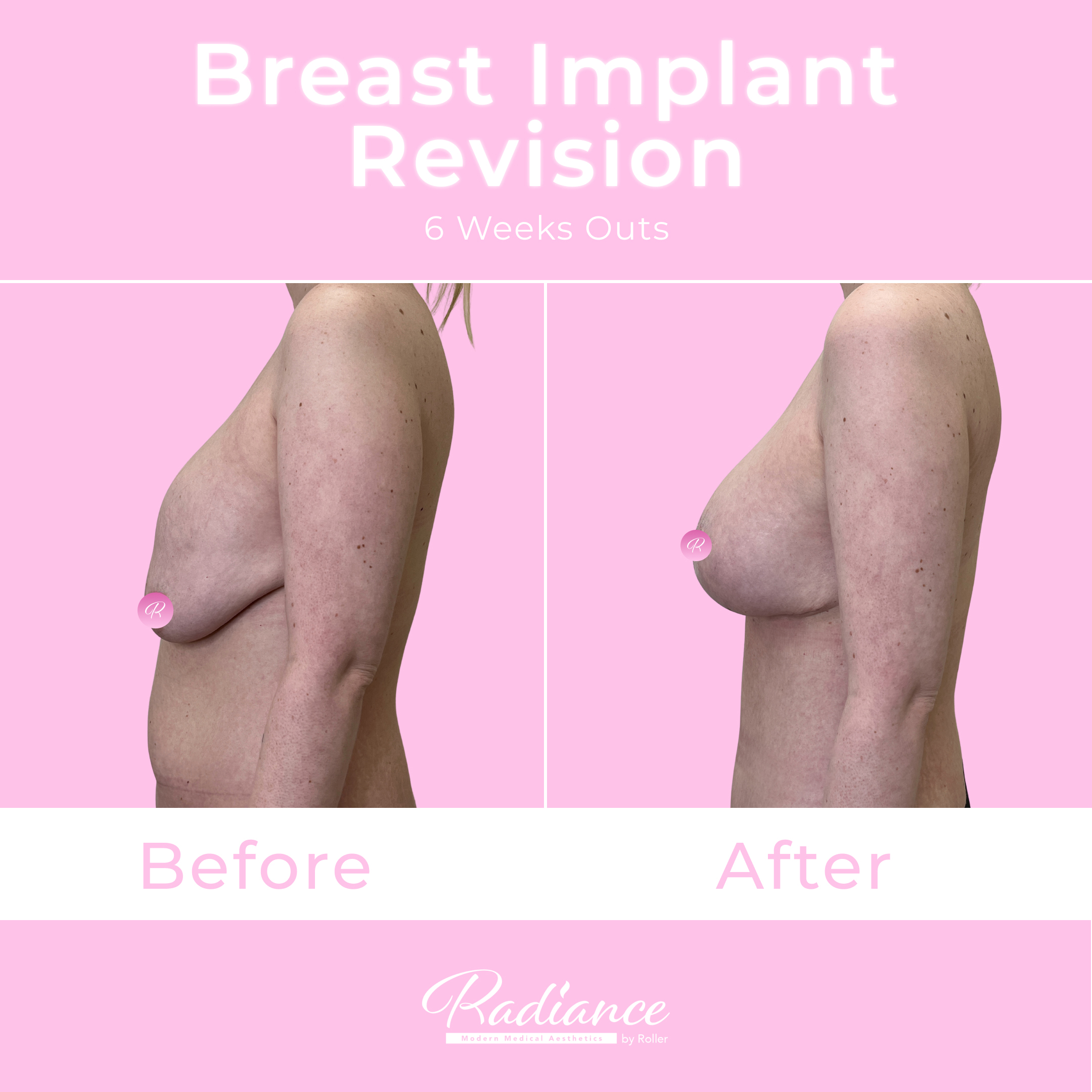 Breast Implant Revision Before & After Gallery - Patient 13430 - Image 3