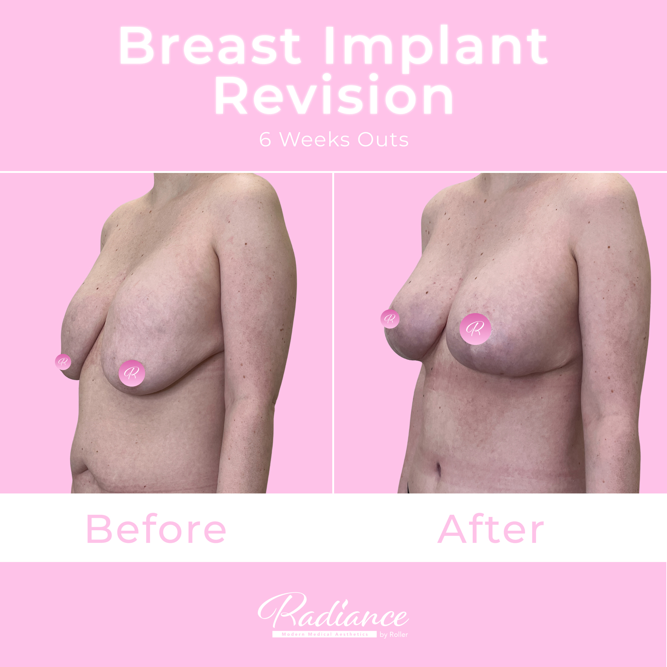 Breast Implant Revision Before & After Gallery - Patient 13430 - Image 2