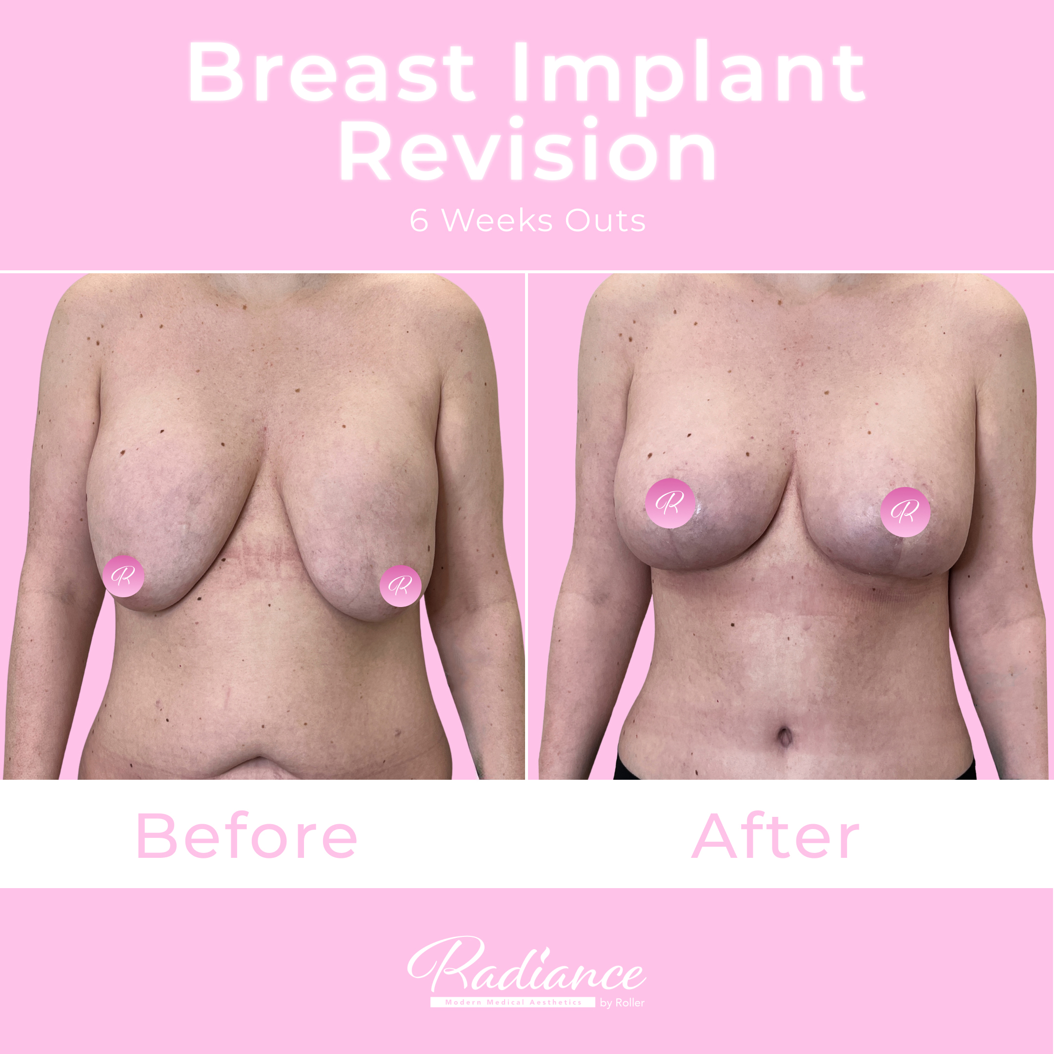 Breast Implant Revision Before & After Gallery - Patient 13430 - Image 1