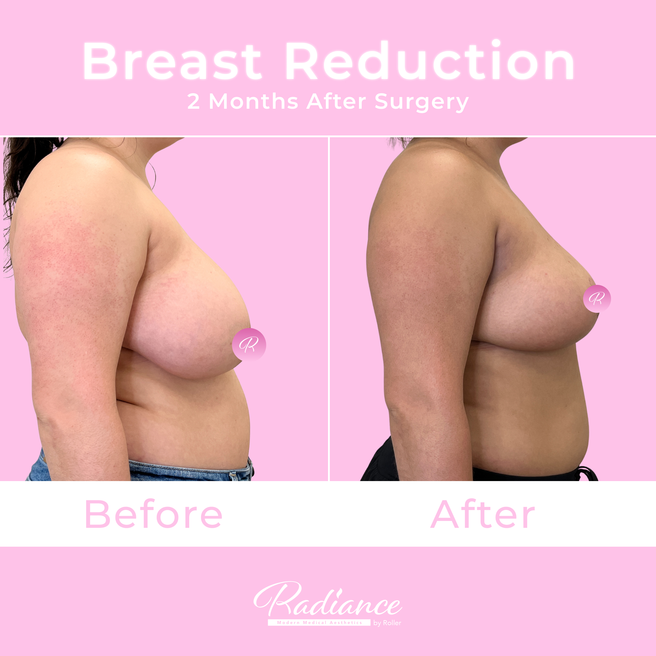Breast Reduction Before & After Gallery - Patient 13402 - Image 3