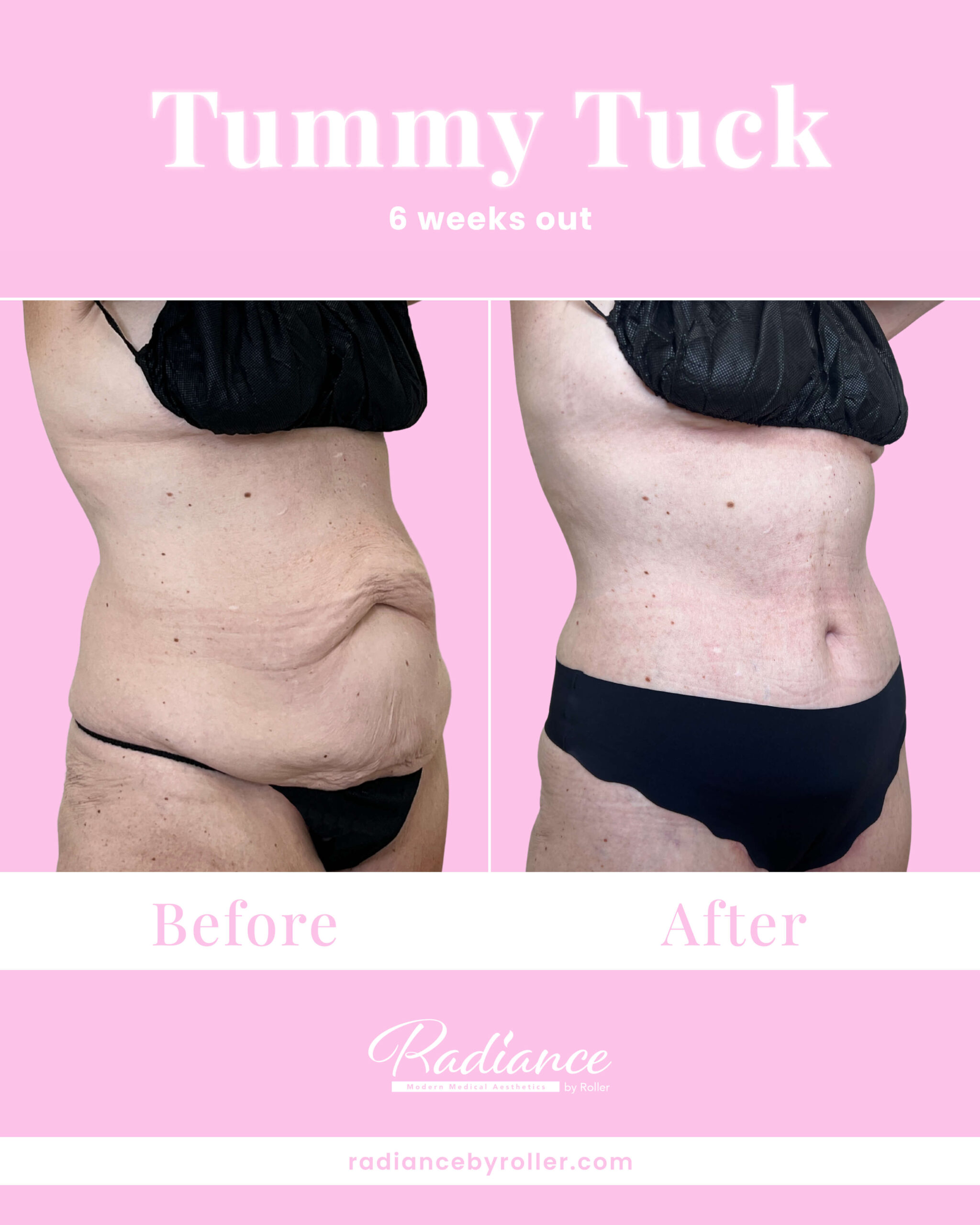 Tummy Tuck Before & After Gallery - Patient 13349 - Image 2