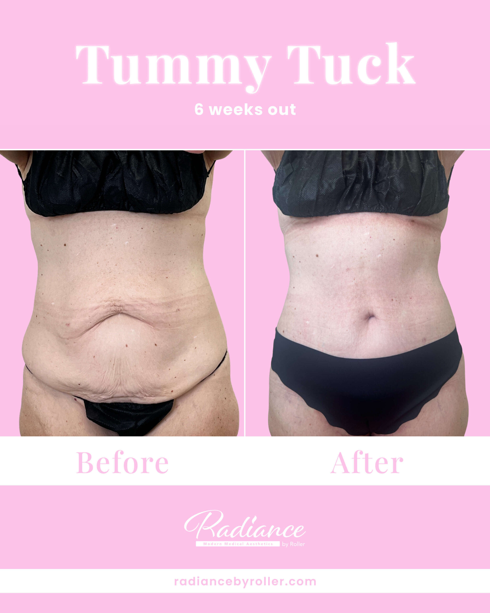 Tummy Tuck Before & After Gallery - Patient 13349 - Image 1