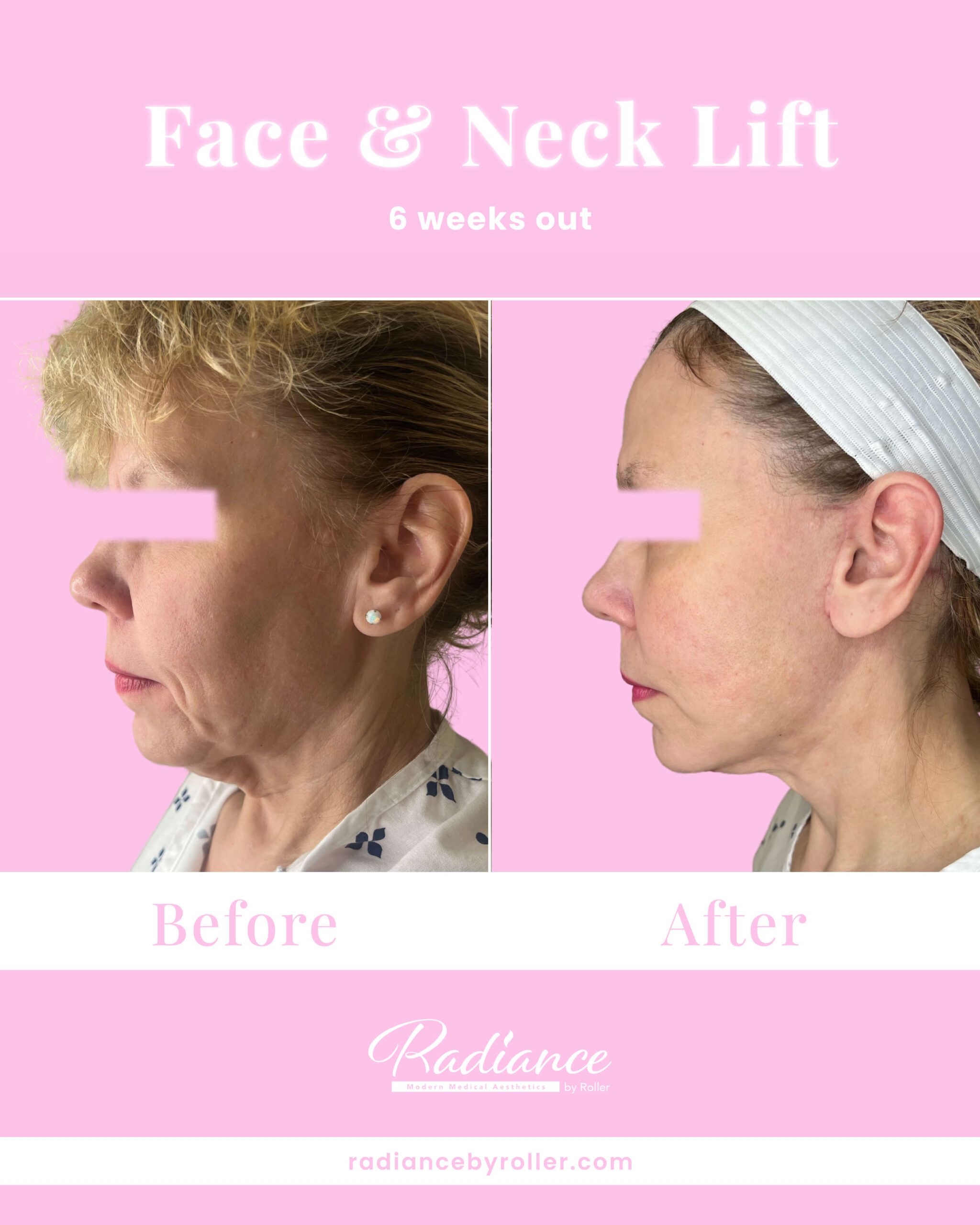 Facelift Before & After Gallery - Patient 13395 - Image 2