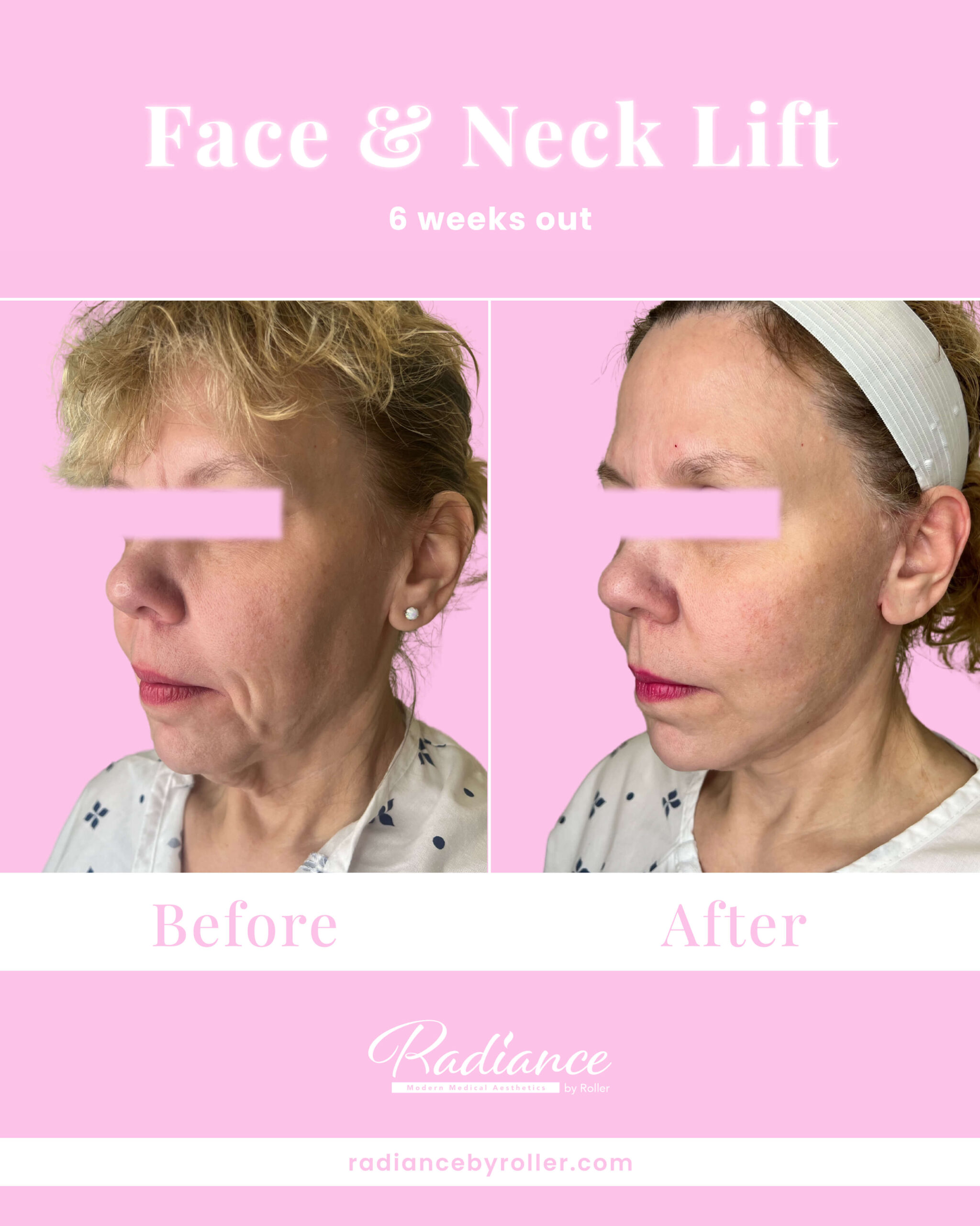 Facelift Before & After Gallery - Patient 13395 - Image 1