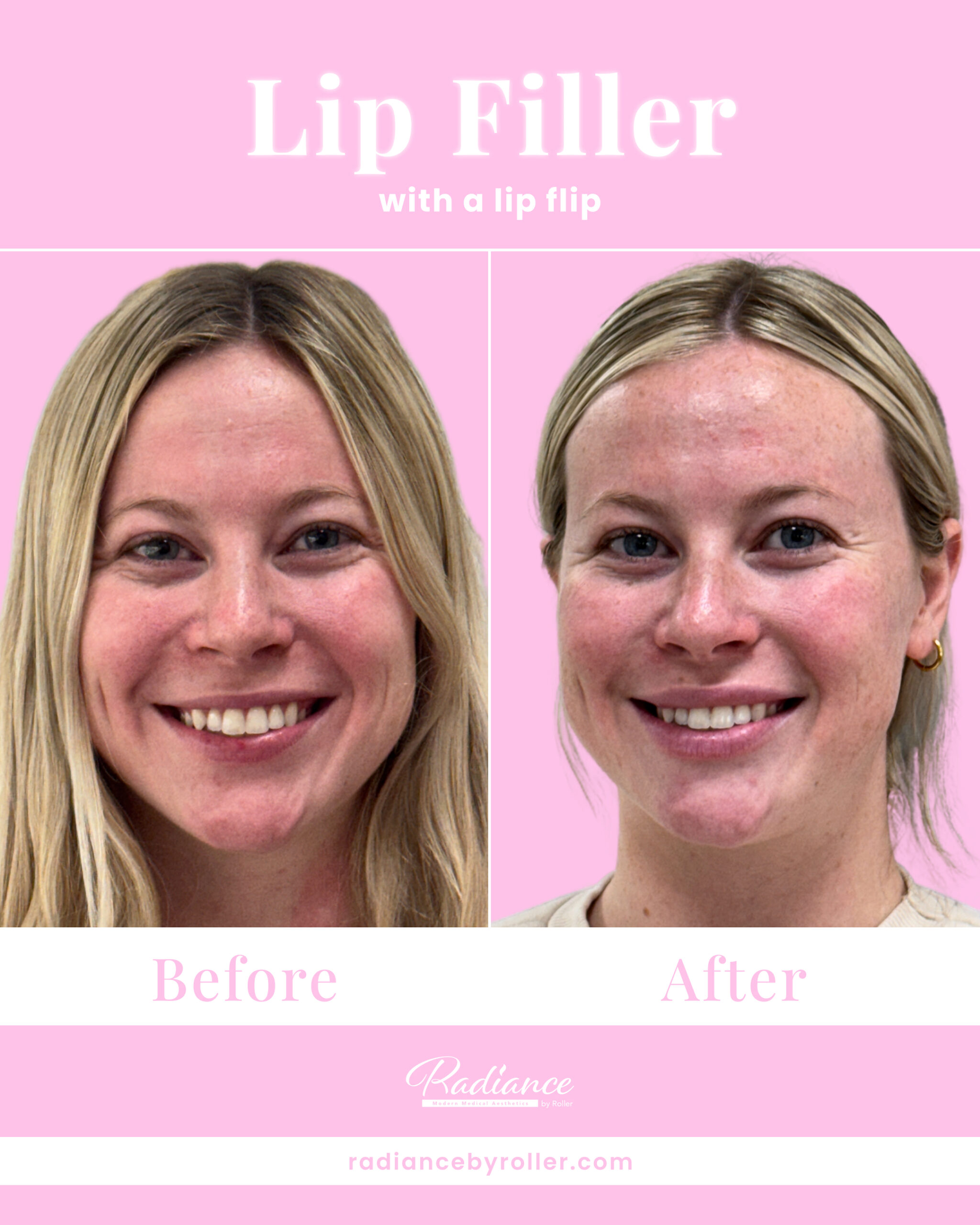 Fillers Before & After Gallery - Patient 12520 - Image 2