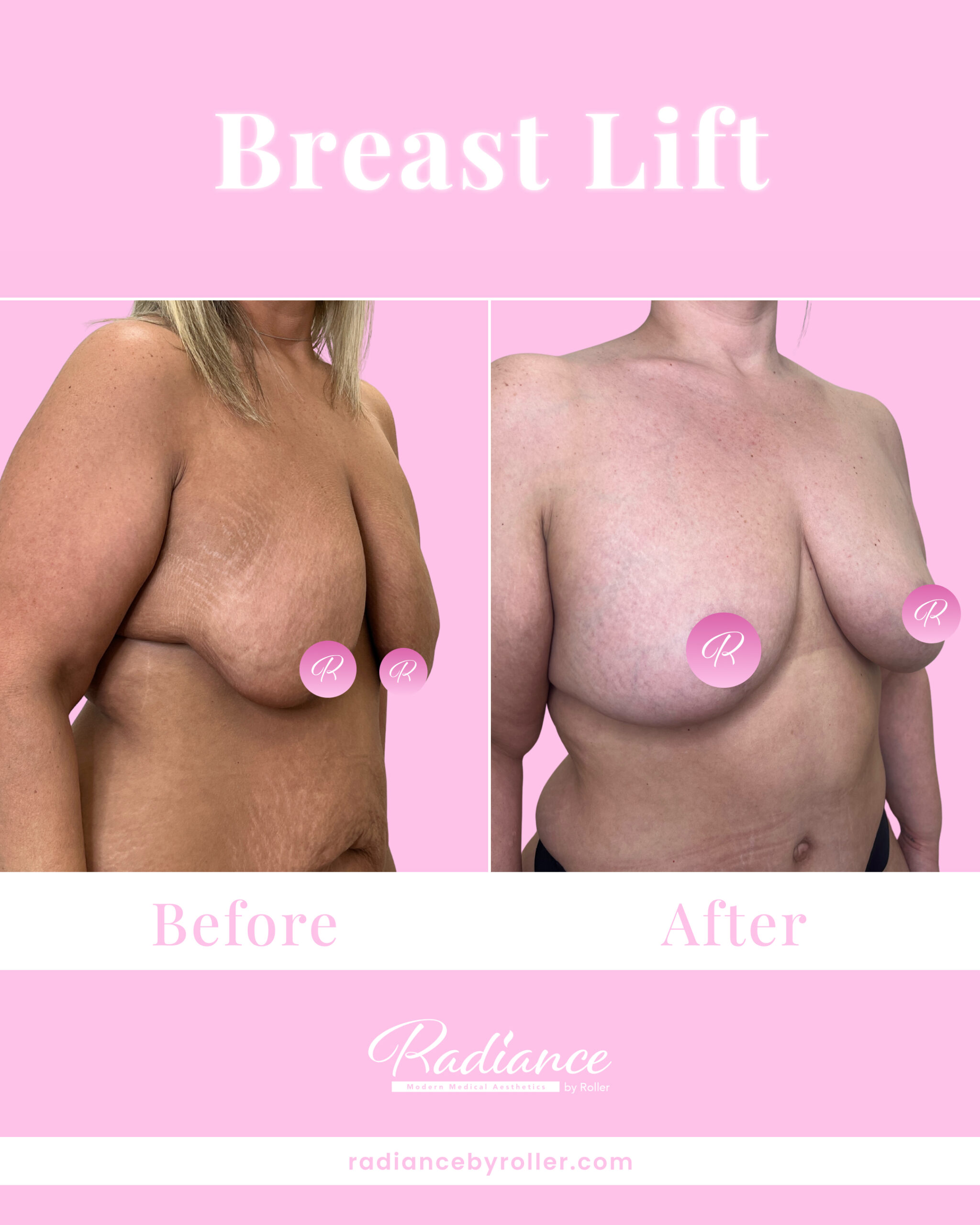 Breast Lift Before & After Gallery - Patient 13420 - Image 2