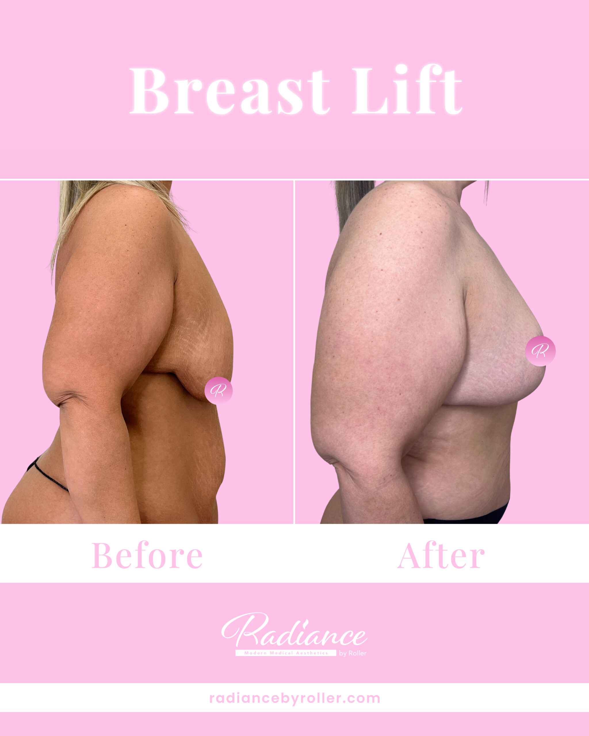 Breast Lift Before & After Gallery - Patient 13420 - Image 3