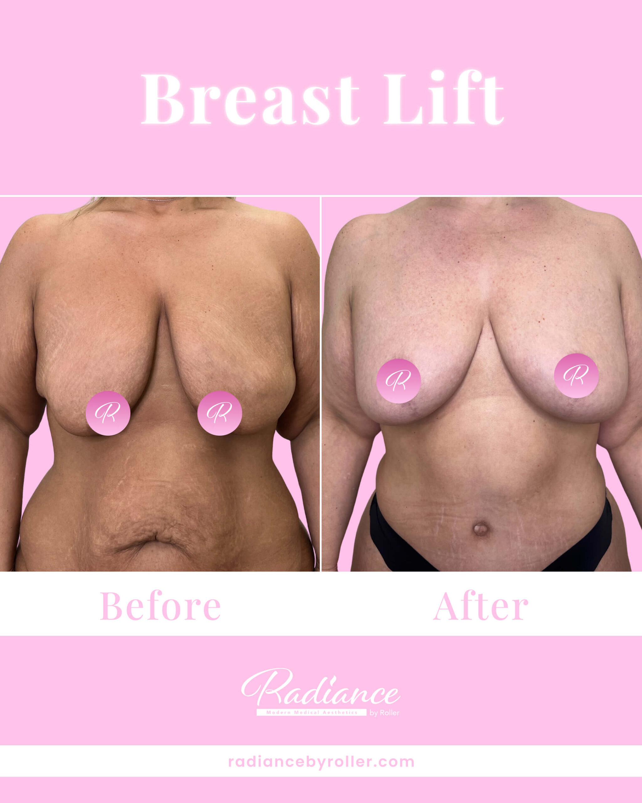 Breast Lift Before & After Gallery - Patient 13420 - Image 1