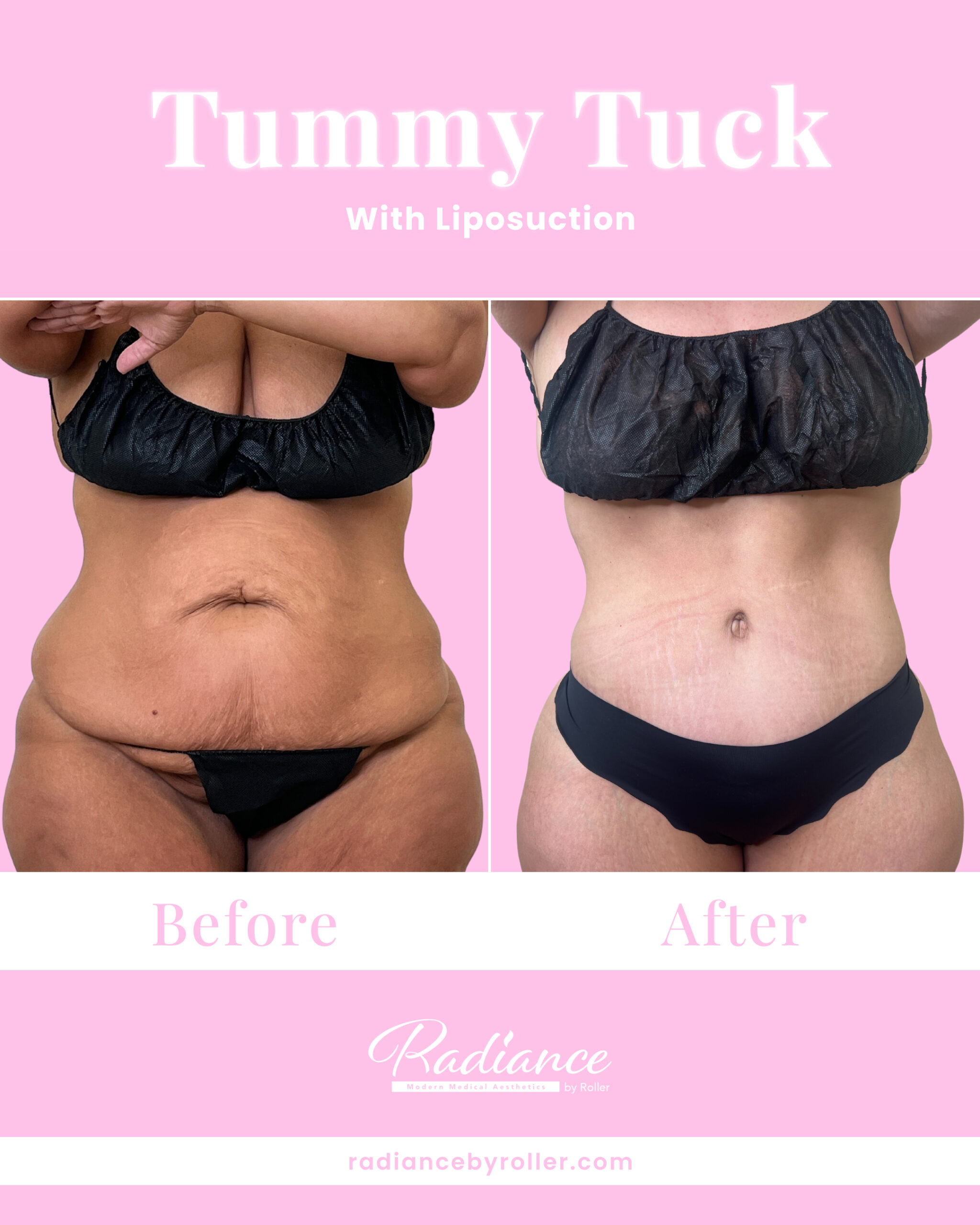 Tummy Tuck Before & After Gallery - Patient 13360 - Image 1