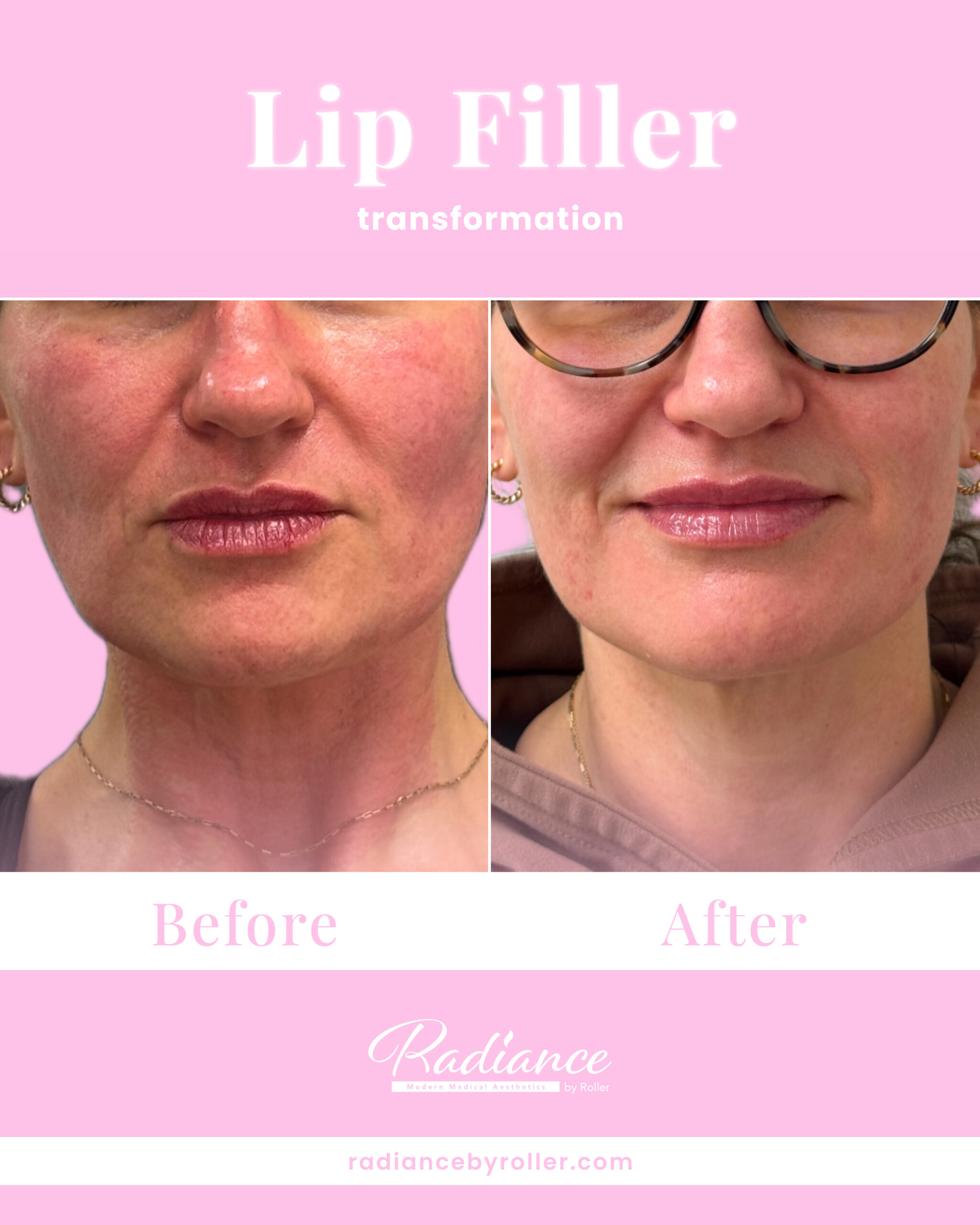 Fillers Before & After Gallery - Patient 12521 - Image 1