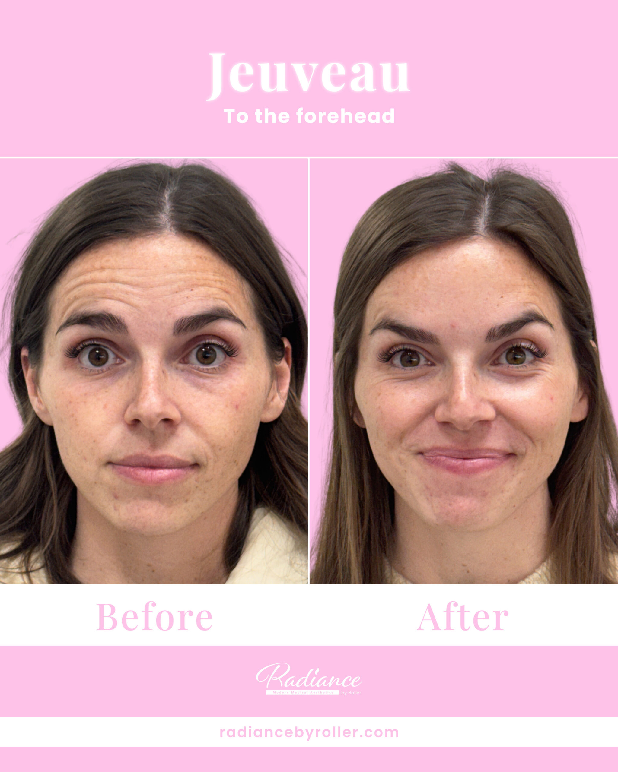 Jeuveau Before & After Gallery - Patient 14721 - Image 1