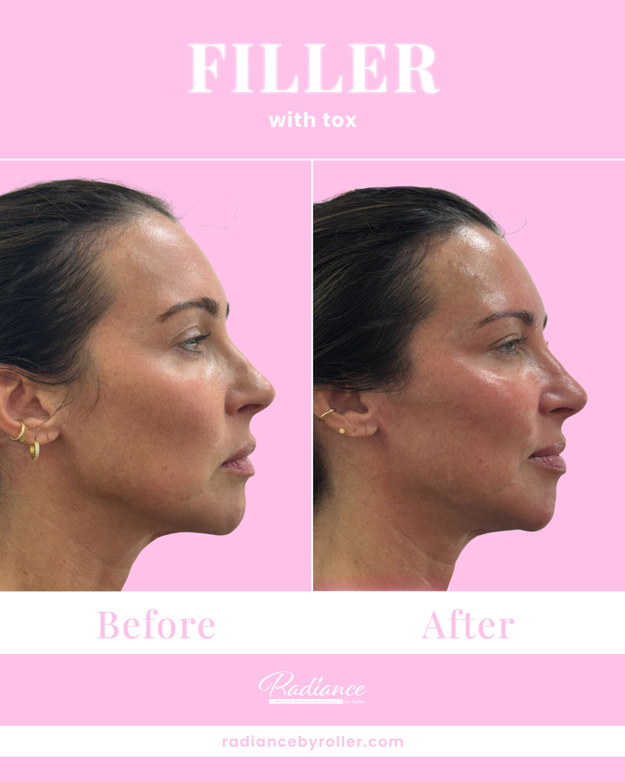 Fillers Before & After Gallery - Patient 14729 - Image 1